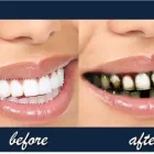 La imagen 2 de la Empresa NELDENT ALTA ESTETICA DENTAL Puestes Removibles Flexibles sin Ganchos de Metal en Guatire M