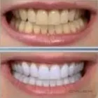 La imagen 8 de la Empresa NELDENT ALTA ESTETICA DENTAL Puestes Removibles Flexibles sin Ganchos de Metal en Guatire M