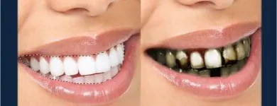 La imagen 2 de la Empresa NELDENT ALTA ESTETICA DENTAL Puestes Removibles Flexibles sin Ganchos de Metal en Guatire M