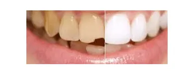 La imagen 4 de la Empresa NELDENT ALTA ESTETICA DENTAL Puestes Removibles Flexibles sin Ganchos de Metal en Guatire M