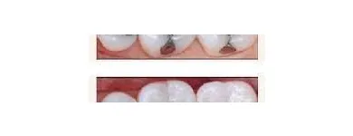 La imagen 7 de la Empresa NELDENT ALTA ESTETICA DENTAL Puestes Removibles Flexibles sin Ganchos de Metal en Guatire M