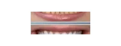 La imagen 8 de la Empresa NELDENT ALTA ESTETICA DENTAL Puestes Removibles Flexibles sin Ganchos de Metal en Guatire M